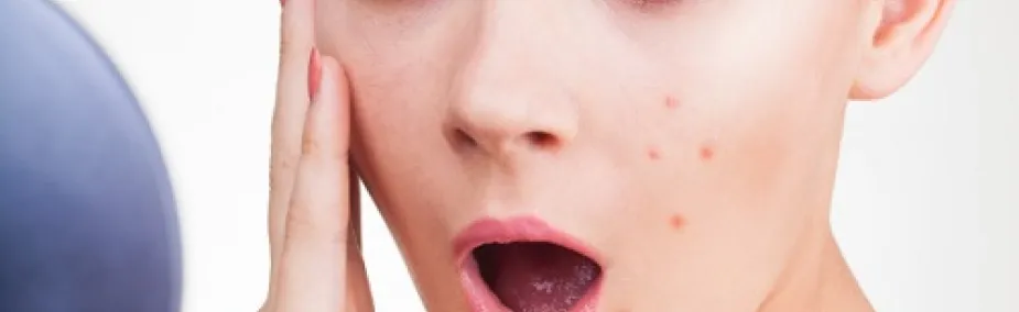 Tratamiento Natural del acné