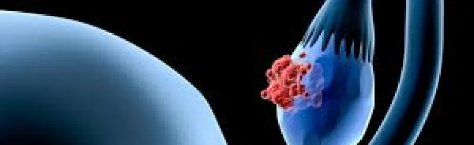 Cáncer de Ovario Tratamiento Natural Tratamiento Natural para el Cáncer de Ovario