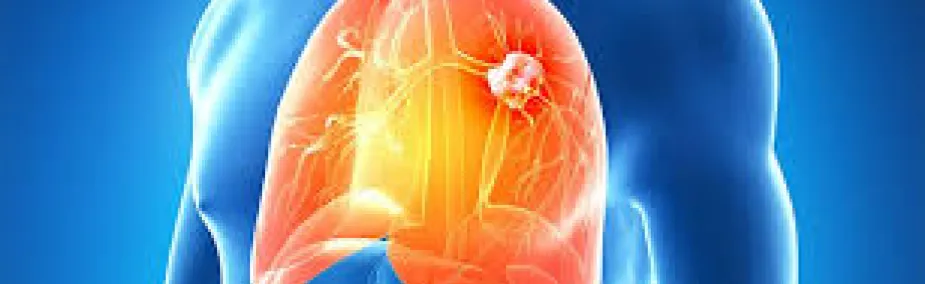 Tratamiento Natural para el cáncer de pulmón