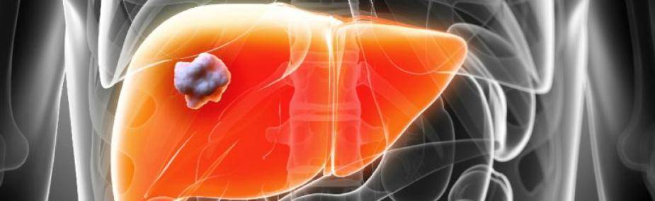 Tratamiento Natural para el Cáncer de Hígado Cáncer de Hígado Tratamiento Natural