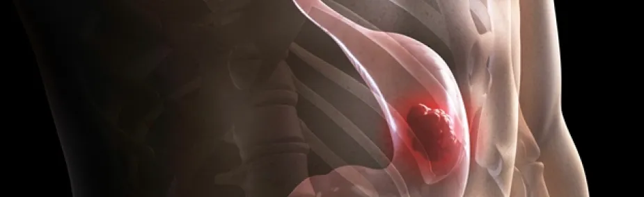 Cáncer de Estómago Tratamiento Natural Tratamiento Natural para el Cáncer de Estómago